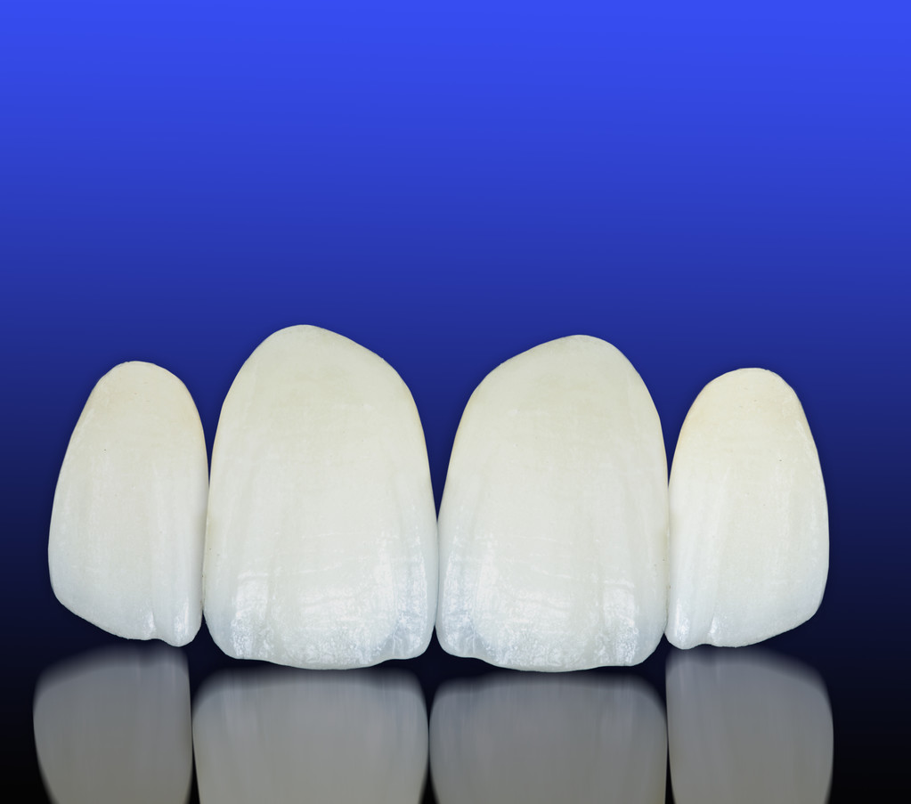 Faccette estetiche