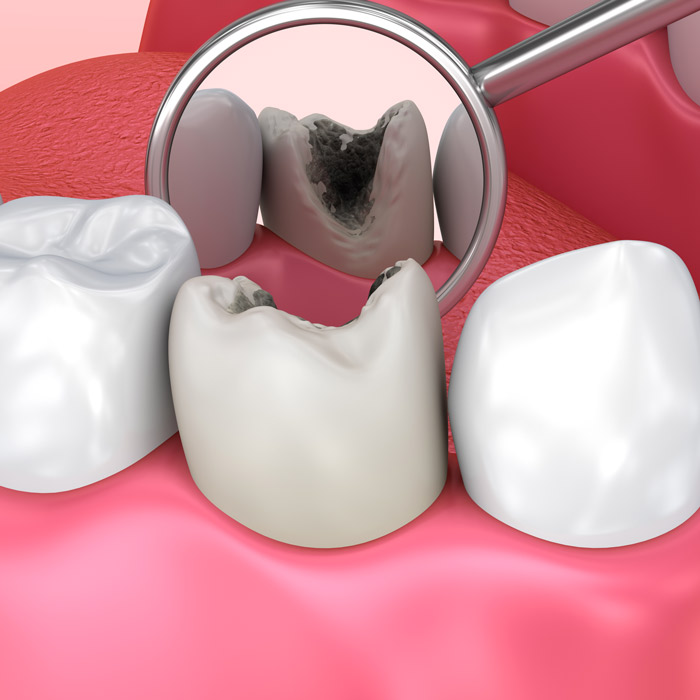 Odontoiatria Conservativa ed Endodonzia