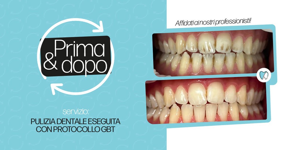 Ablazione del Tartaro con Protocollo GBT a Sessa Aurunca