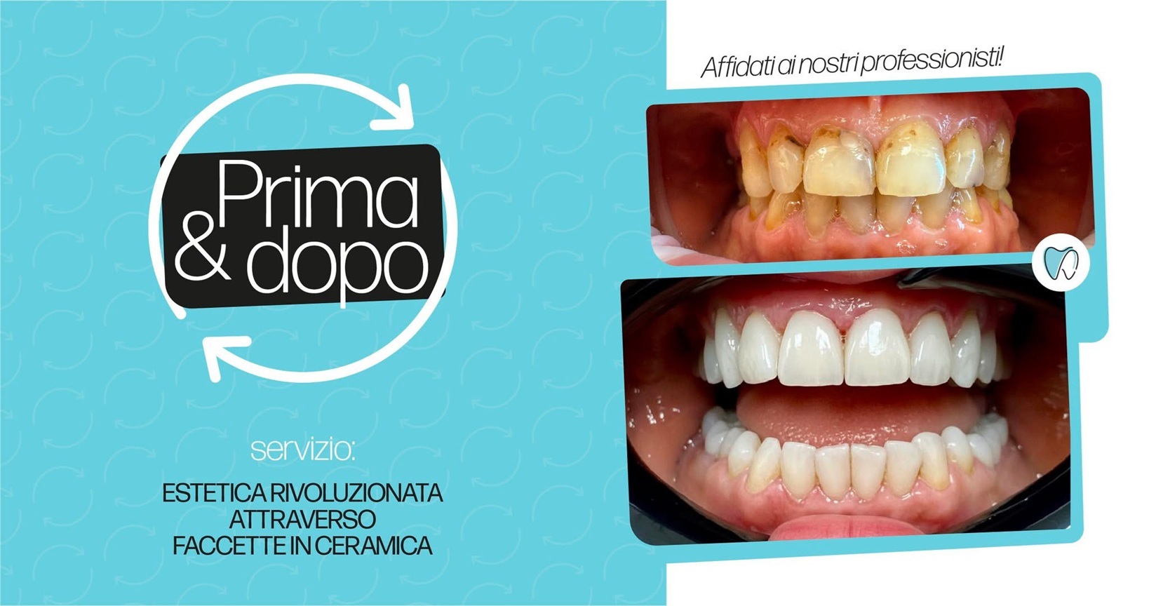 Faccette Estetiche Dentali a Sessa Aurunca
