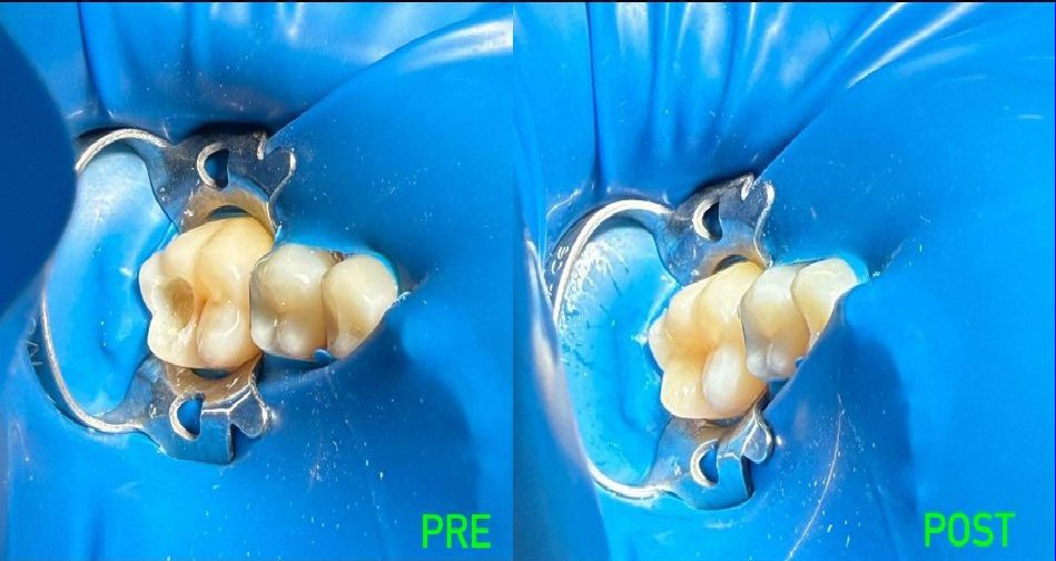 Odontoiatria Conservativa ed Endodonzia a Sessa Aurunca